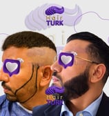 beard transplant clinic in turkey before after