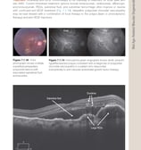 IMAGEM DE UM EXAME DE OCT COM DEGFENERAÇÃO MACULAR RELACIONADO A IDADE
