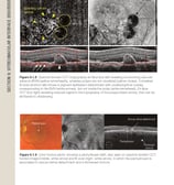 a page of a OCT book with a picture of a OCT edema macular diabético