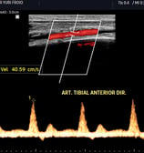 Artéria tibial anterior com fluxo normal ao Doppler