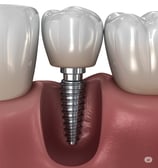 implants dentaires Tunisie