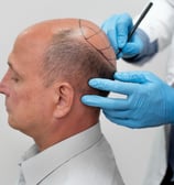 greffe de cheveux Tunisie