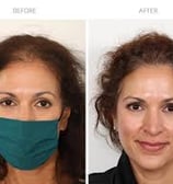 Hair transplant
