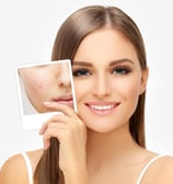 Skindent's Rejuvenate Acne Treatment Services