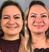 tratamento colageno e biostimulador
