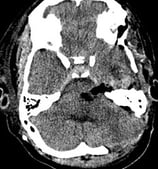 Tomografia após a cirurgia no cérebro e remoção do cavernoma.