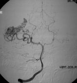 Angiografia vértebro-basilar projeção frontal mostrando a MAV.