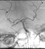 Angiografia digital projeção frontal após a cirurgia no cérebro e clipagem do aneurisma cerebral.