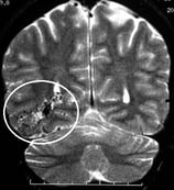 Ressonância nuclear magnética de encéfalo. O círculo mostra a MAV temporal posterior direita.