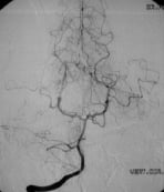 Angiografia vértebro-basilar projeção frontal após a cirurgia no cérebro e remoção da MAV. 