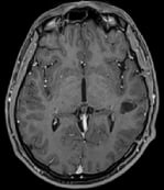 Ressonância após a cirurgia com remoção total do cavernoma e paciente livre de epilepsia.