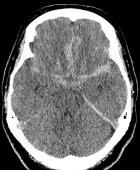 Tomografia de crânio demonstrando hemorragia intracerebral.