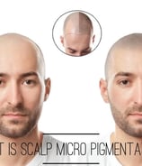 Rejuvenate Aesthetics and Dental Care- Scalp Micro Pigmentation Services
