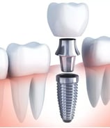 a dental implanting implanting a toothbrush and dental implant