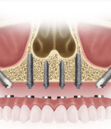 a dental implanting procedure for implanting teeth