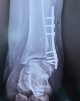 Placa para Peroné Distal