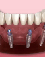 a dental implanting implanting teeth and implants