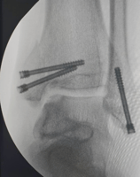 Tornillos canulados tipo Herbert