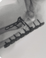 Placa de reconstrucción y placa para radio proximal