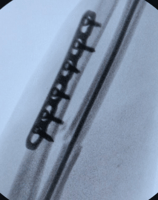 Placa recta y clavo TEN