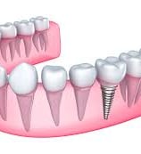 a dental implanting implanting teeth and teeth