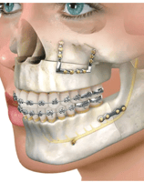 a dental implanting implanting teeth and implants