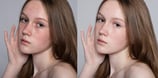 blemishes-and-scars-removal