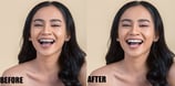 brace-removal