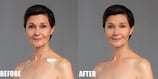 Remove Wrinkles Before and After