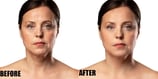 wrinkle-removal