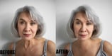 wrinkle-or-scar-marks-removal