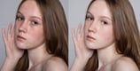 blemishes-and-scars-removal