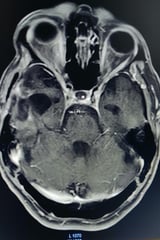 Subtotal removal of tumour