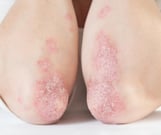 Psoriasis