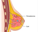 Fibroadenoma Of Breast