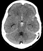 Tomografia computadorizada de crânio mostrando hemorragia intracerebral e hidrocefalia.