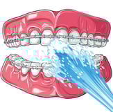 jet dentaire ozone orthodontie aquolab hygiene-precision