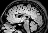 Ressonância de homem de 34 anos com epilepsia desde 10 meses e quedas desde 10 anos.