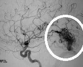 Angiografia carotídea perfil mostrando a MAV.