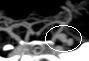 Angiotomografia projeção frontal. O círculo mostra o aneurisma cerebral.
