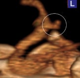 Angiotomografia perfil mostrando um aneurisma cerebral (círculo).