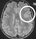 Ressonância de menino de 7 anos com epilepsia desde os 3 anos.