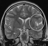 Ressonância de menino de 13 anos com epilepsia desde 2 anos com displasia fronto-insular esquerda.