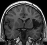 Ressonância após a cirurgia no cérebro e remoção total da displasia. Ele ficou livre da epilepsia.