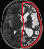 Ressonância de menina de 8 anos com epilepsia desde os 3. Atrofia do hemisfério cerebral esquerdo.