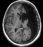 Ressonância após a cirurgia no cérebro com a hemisferotomia. Ela ficou livre da epilepsia.