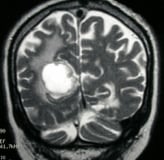 Ressonância de paciente com câncer de pulmão e tumor occipital direito antes da cirurgia no cérebro.