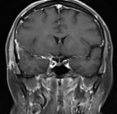 Resoonância magnética após a cirurgia mostrando a retirada total do meningeoma.