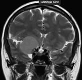 Ressonância de paciente com cefaleia e tumor petroclinoideo direito antes da cirurgia no cérebro.   