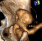 Angiotomografia 3D de mulher de 48 anos. O círculo indica o volumoso aneurisma cerebral.